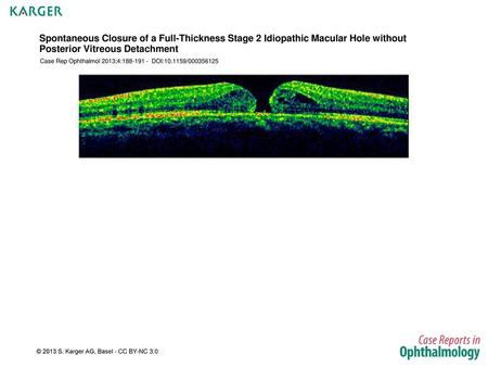 Spontaneous Closure of a Full-Thickness Stage 2 Idiopathic Macular Hole without Posterior Vitreous Detachment Case Rep Ophthalmol 2013;4:188-191 - DOI:10.1159/000356125.