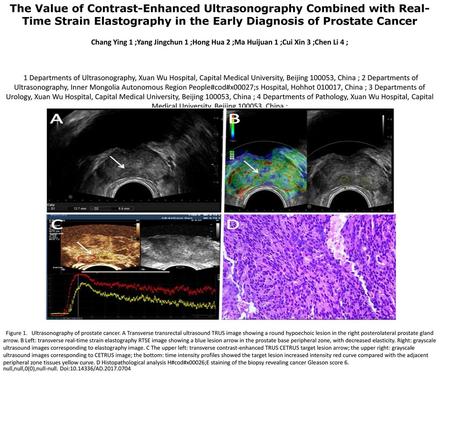 The Value of Contrast-Enhanced Ultrasonography Combined with Real-Time Strain Elastography in the Early Diagnosis of Prostate Cancer Chang Ying 1 ;Yang.