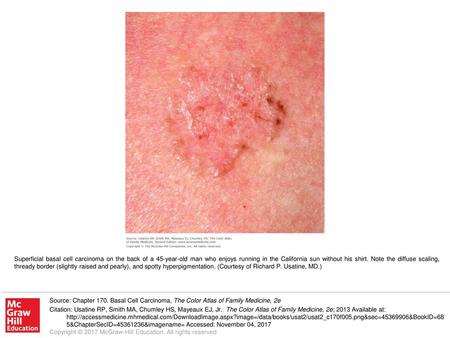 Superficial basal cell carcinoma on the back of a 45-year-old man who enjoys running in the California sun without his shirt. Note the diffuse scaling,