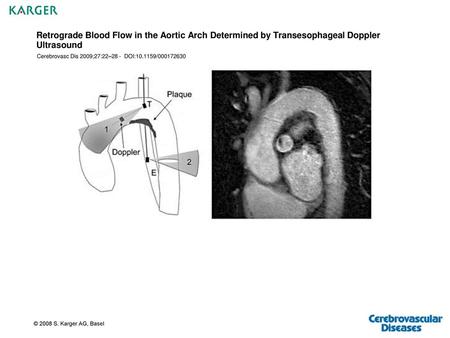 Retrograde Blood Flow in the Aortic Arch Determined by Transesophageal Doppler Ultrasound Cerebrovasc Dis 2009;27:22–28 - DOI:10.1159/000172630 © 2008.