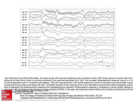 Eye Fluttering During Photic Stimulation