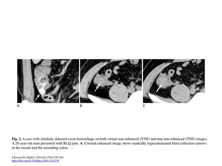 HU = Hounsfield unit, RLQ = right lower quadrant