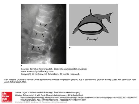 Fish vertebra. (A) Lateral view of lumbar spine shows endplate compression (arrows) due to osteoporosis. (B) Fish drawing (Used with permission from Arash.