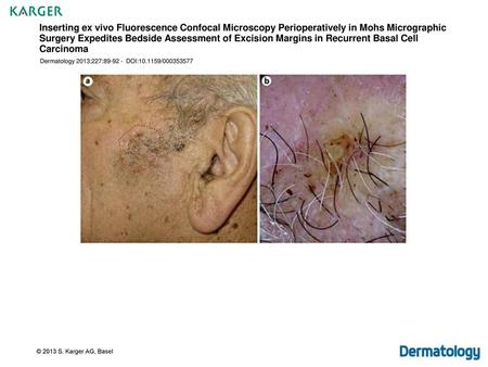 Inserting ex vivo Fluorescence Confocal Microscopy Perioperatively in Mohs Micrographic Surgery Expedites Bedside Assessment of Excision Margins in Recurrent.