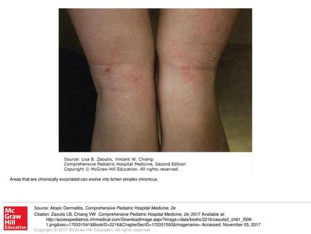 Areas that are chronically excoriated can evolve into lichen simplex chronicus. Source: Atopic Dermatitis, Comprehensive Pediatric Hospital Medicine, 2e.