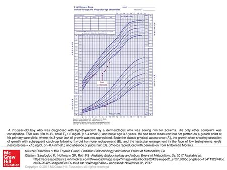 A 7.8-year-old boy who was diagnosed with hypothyroidism by a dermatologist who was seeing him for eczema. His only other complaint was constipation. TSH.