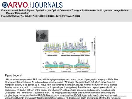 From: Activated Retinal Pigment Epithelium, an Optical Coherence Tomography Biomarker for Progression in Age-Related Macular Degeneration Invest. Ophthalmol.