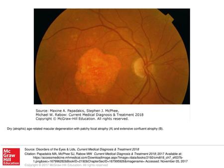 Dry (atrophic) age-related macular degeneration with patchy focal atrophy (A) and extensive confluent atrophy (B). Source: Disorders of the Eyes & Lids,