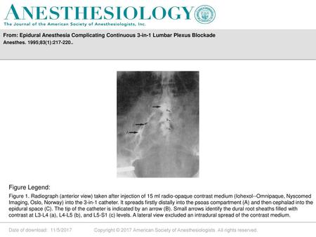 From: Epidural Anesthesia Complicating Continuous 3-in-1 Lumbar Plexus Blockade Figure Legend: Figure 1. Radiograph (anterior view) taken after injection.