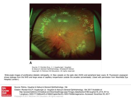 Wide-angle images of proliferative diabetic retinopathy