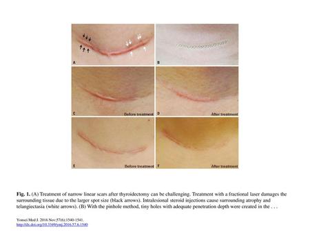 Fig. 1. (A) Treatment of narrow linear scars after thyroidectomy can be challenging. Treatment with a fractional laser damages the surrounding tissue due.