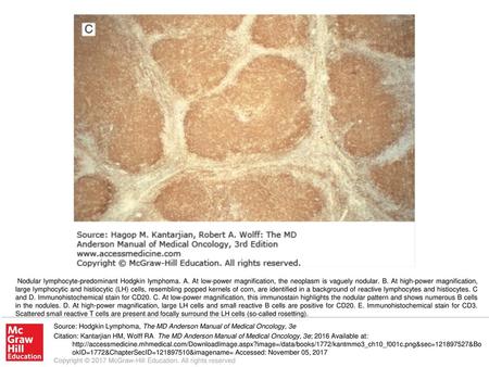 Nodular lymphocyte-predominant Hodgkin lymphoma. A