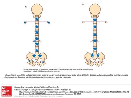 (a) Ankylosing spondylitis and psoriasis: main target areas on vertebral column and girdle joints (b) Crohn disease and ulcerative colitis: main target.