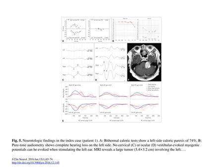 Fig. 5. Neurotologic findings in the index case (patient 1)