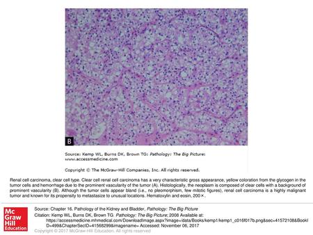 Renal cell carcinoma, clear cell type