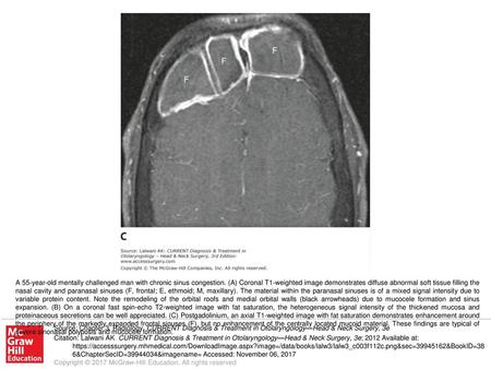 A 55-year-old mentally challenged man with chronic sinus congestion