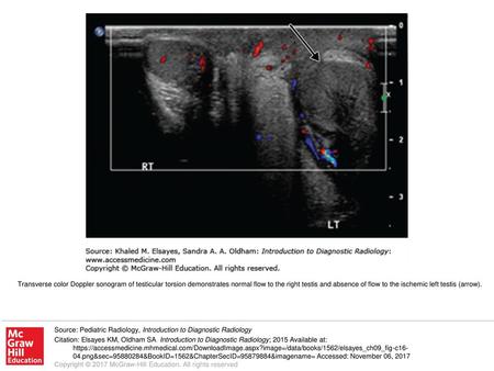 Transverse color Doppler sonogram of testicular torsion demonstrates normal flow to the right testis and absence of flow to the ischemic left testis (arrow).