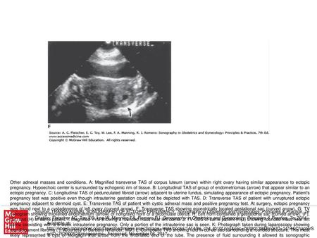 Other adnexal masses and conditions