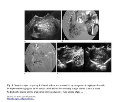 Fig. 5. Cornual ectopic pregnancy. A