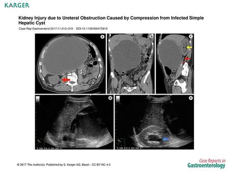 Case Rep Gastroenterol 2017;11:312– DOI: /