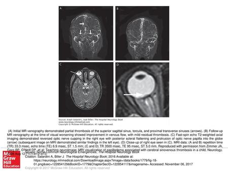 (A) Initial MR venography demonstrated partial thrombosis of the superior sagittal sinus, torcula, and proximal transverse sinuses (arrows). (B) Follow-up.