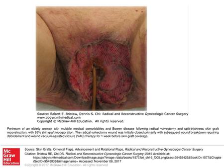 Perineum of an elderly woman with multiple medical comorbidities and Bowen disease following radical vulvectomy and split-thickness skin graft reconstruction,