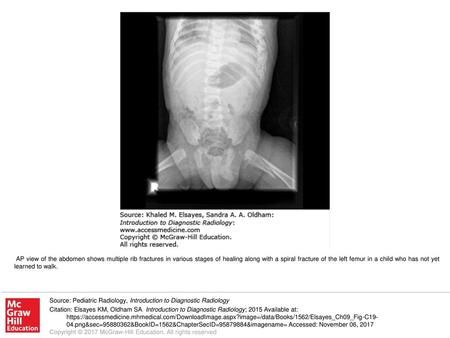 AP view of the abdomen shows multiple rib fractures in various stages of healing along with a spiral fracture of the left femur in a child who has not.