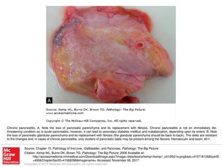 Chronic pancreatitis. A, Note the loss of pancreatic parenchyma and its replacement with fibrosis. Chronic pancreatitis is not an immediately life-threatening.