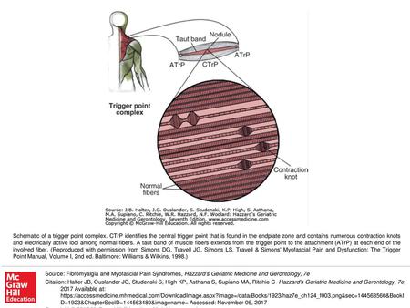 Schematic of a trigger point complex