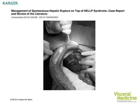 Management of Spontaneous Hepatic Rupture on Top of HELLP Syndrome: Case Report and Review of the Literature Viszeralmedizin 2015;31:205-208 - DOI:10.1159/000376601.