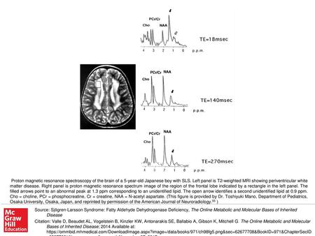 Proton magnetic resonance spectroscopy of the brain of a 5-year-old Japanese boy with SLS. Left panel is T2-weighted MRI showing periventricular white.