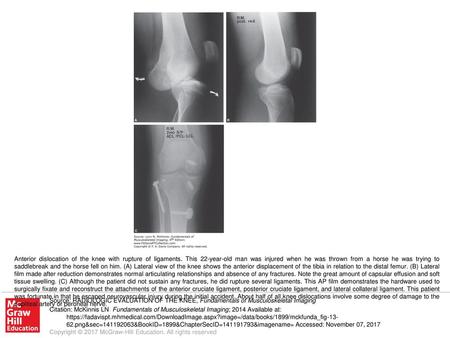 Anterior dislocation of the knee with rupture of ligaments