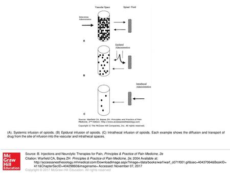 (A). Systemic infusion of opioids. (B) Epidural infusion of opioids