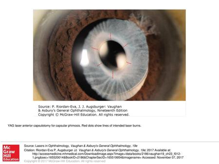 YAG laser anterior capsulotomy for capsular phimosis