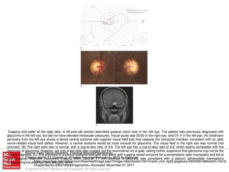 Cupping and pallor of the optic disc