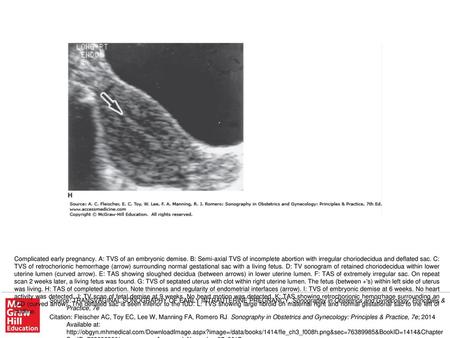 Complicated early pregnancy. A: TVS of an embryonic demise