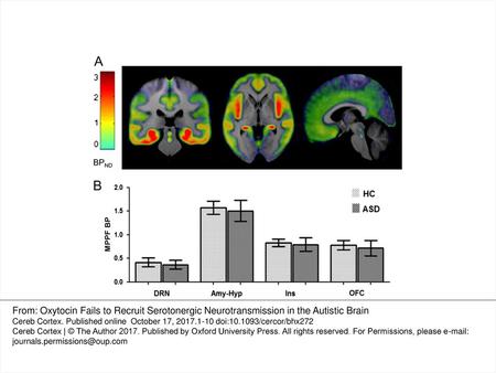 Figure 1. (A) Mean MPPF BPND concentration at basal state in ASD patients group (N = 18), color bar = MPPF BPND value. The color bar represents.