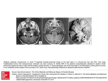 Bilateral vestibular schwannoma