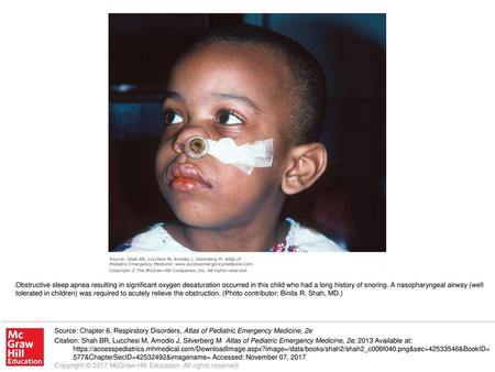 Obstructive sleep apnea resulting in significant oxygen desaturation occurred in this child who had a long history of snoring. A nasopharyngeal airway.