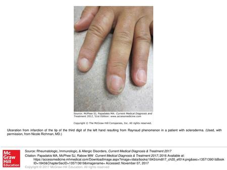 Ulceration from infarction of the tip of the third digit of the left hand resulting from Raynaud phenomenon in a patient with scleroderma. (Used, with.