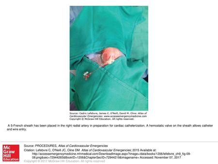 A 5-French sheath has been placed in the right radial artery in preparation for cardiac catheterization. A hemostatic valve on the sheath allows catheter.