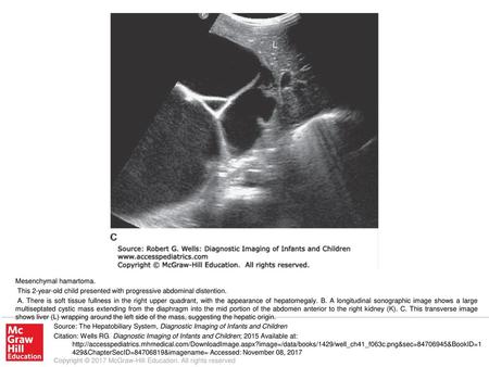 A. There is soft tissue fullness in the right upper quadrant, with the appearance of hepatomegaly. B. A longitudinal sonographic image shows a large multiseptated.