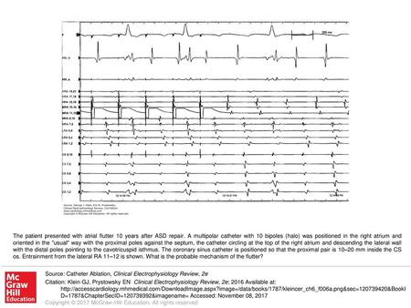 The patient presented with atrial flutter 10 years after ASD repair