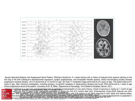 Ohtahara syndrome is a very rare and devastating form of epileptic encephalopathy of very early infancy. Onset of seizures is mainly by 1 month of age.