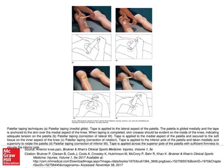 Patellar taping techniques (a) Patellar taping (medial glide)