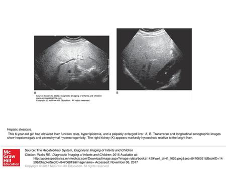 This 6-year-old girl had elevated liver function tests, hyperlipidemia, and a palpably enlarged liver. A, B. Transverse and longitudinal sonographic images.