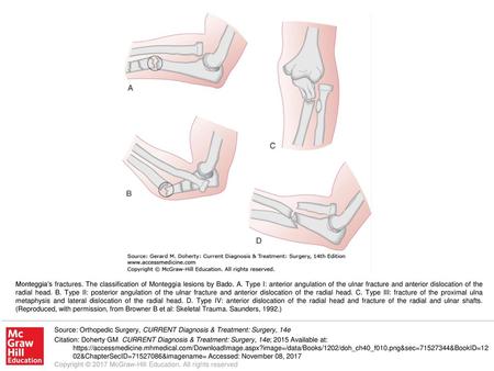 Monteggia’s fractures. The classification of Monteggia lesions by Bado