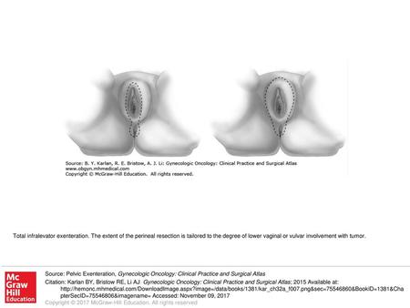 Total infralevator exenteration