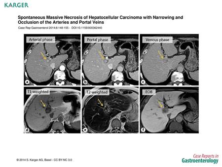 Spontaneous Massive Necrosis of Hepatocellular Carcinoma with Narrowing and Occlusion of the Arteries and Portal Veins Case Rep Gastroenterol 2014;8:148-155.