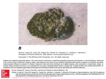 Atypical and malignant pigmented lesions